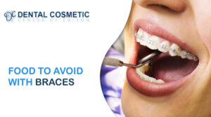 Food to avoid with braces