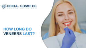 How Long Do Veneers Last?