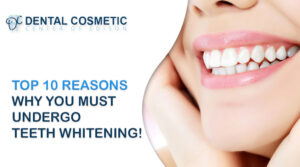 TOP 10 Reasons Why you must undergo teeth whitening!